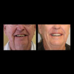 A man with a missing tooth and before and after