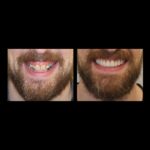 Bearded man before and after dental restoration