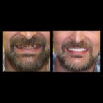 A man with a beard and mustache before and after teeth whitening.