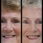 A before and after picture of an older woman 's smile.