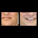 Before and after smile restoration