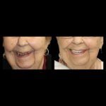 A before and after photo of an older woman 's teeth.
