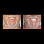 A before and after picture of the teeth that were restored.