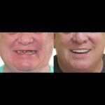 A man with missing teeth and before and after photos of his smile.