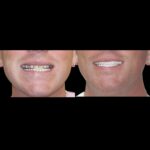 Before-and-after dental smile transformation