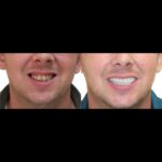 A man with missing teeth and his smile is shown.