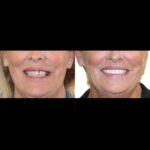 Before-and-after dental smile makeover
