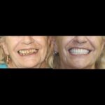 Before-and-after smile makeover: stained to bright teeth