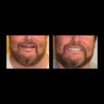 A man with beard and mustache before and after teeth whitening.
