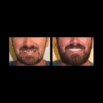 Before-and-after male dental restoration smile