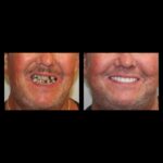 A man with missing teeth and his smile restored.