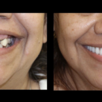 A before and after picture of the teeth whitening process.
