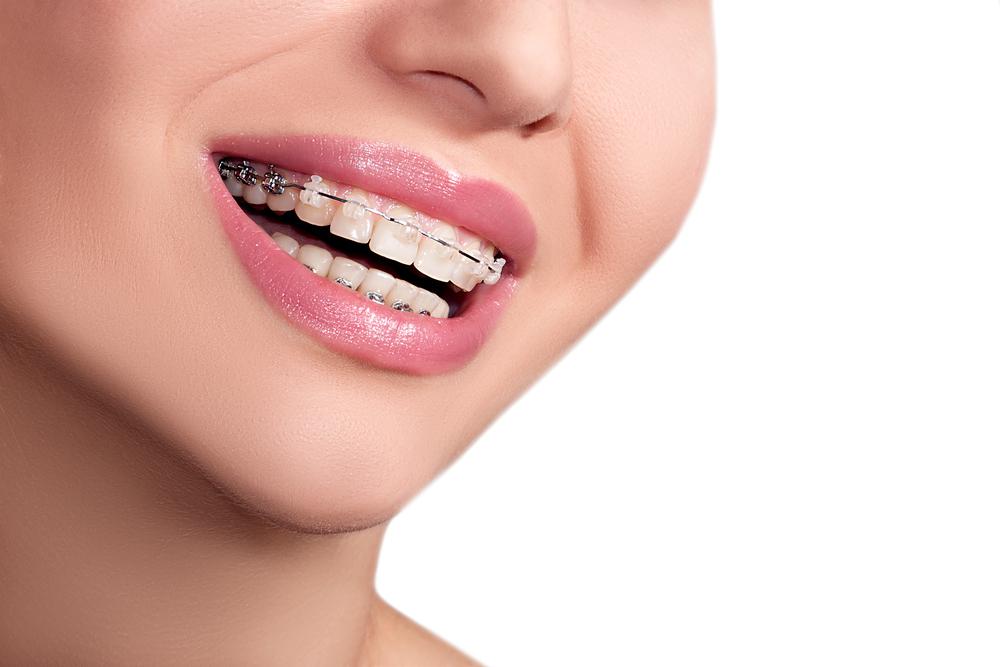 Smiling woman with braces on teeth.