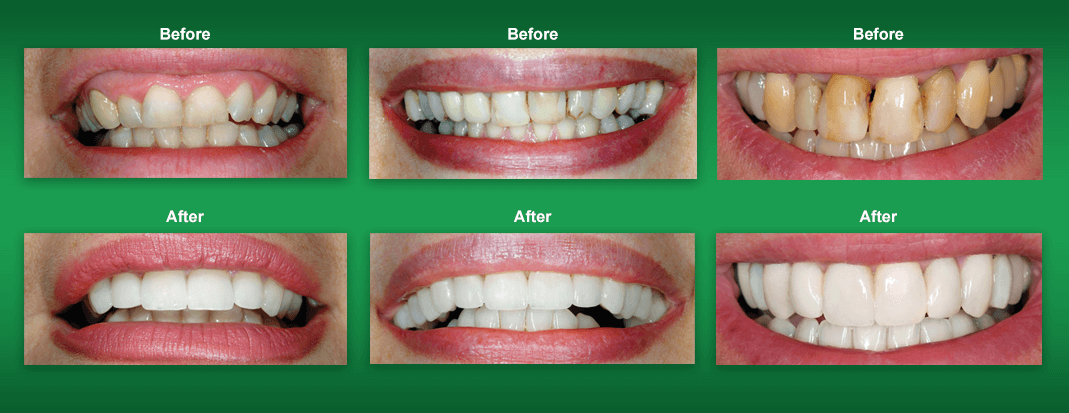Smile Makeover Dentistry in The Villages FL