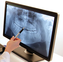 Digital Dental Xrays The Villages FL