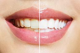 Teeth Whitening Dentist The Villages FL