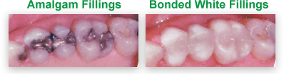 White Dental Fillings - The Villages FL